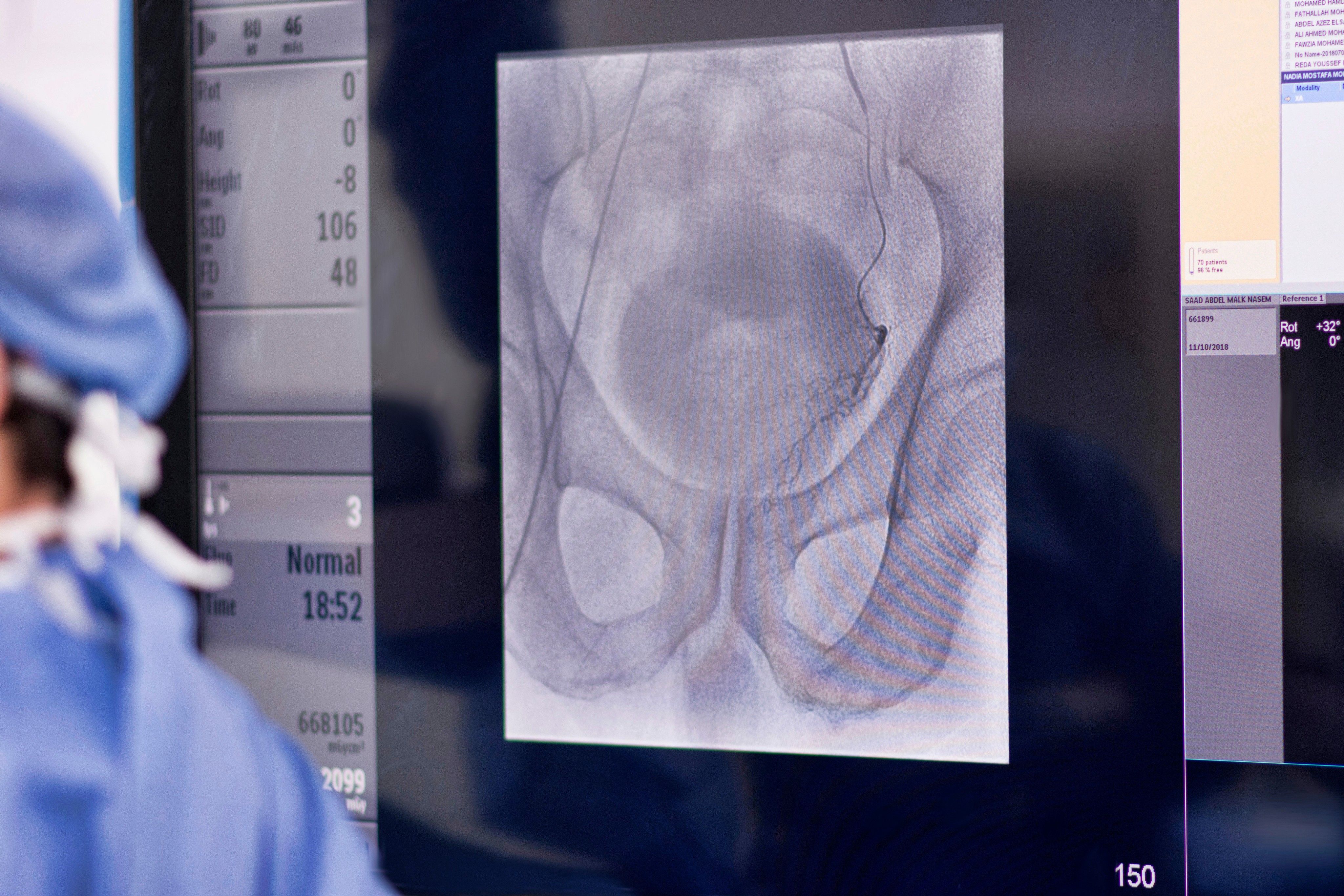 Interventional Radiologist performing Prostatic artery embolization (PAE)
